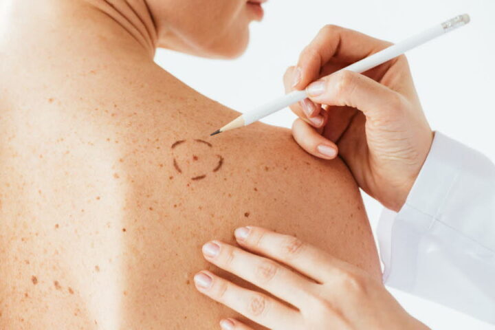 Mélanome en France : 18 000 nouveaux cas annuels et avancées dans le dépistage et le traitement