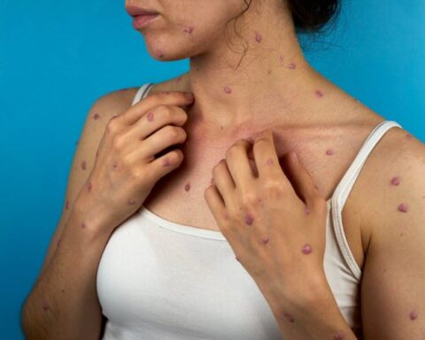 Mpox : une enquête révèle que les écureuils pourraient être les réservoirs du virus