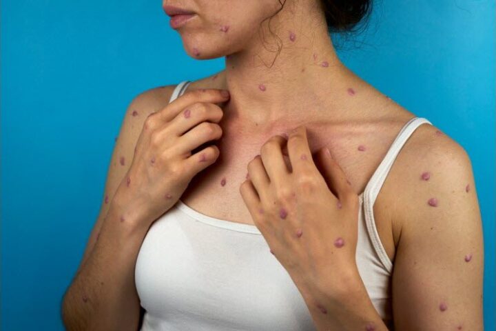 Mpox : une enquête révèle que les écureuils pourraient être les réservoirs du virus