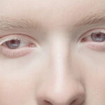 Albinisme : comprendre cette maladie rare aux implications cutanées et visuelles