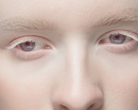 Albinisme : comprendre cette maladie rare aux implications cutanées et visuelles