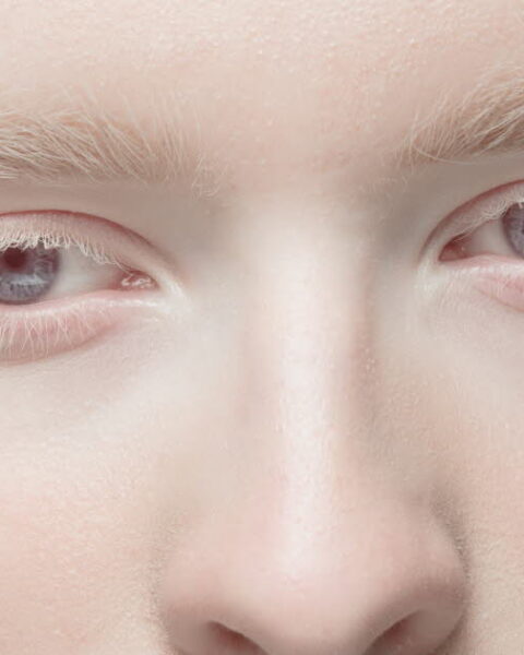 Albinisme : comprendre cette maladie rare aux implications cutanées et visuelles