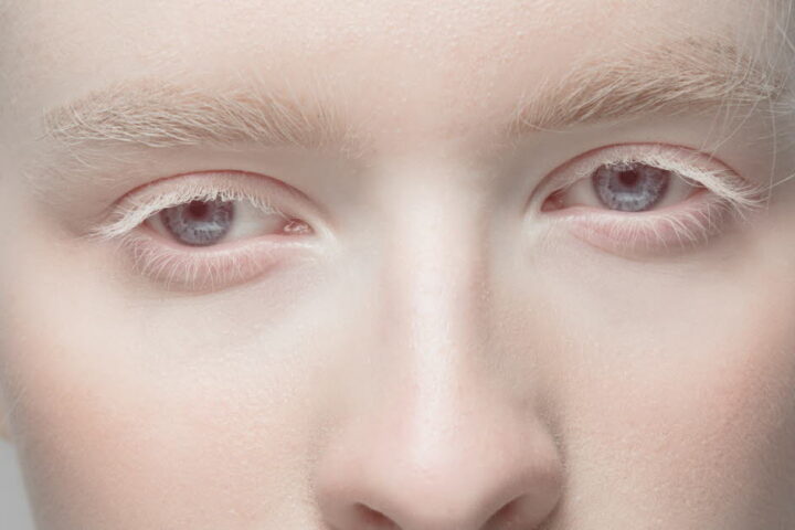 Albinisme : comprendre cette maladie rare aux implications cutanées et visuelles