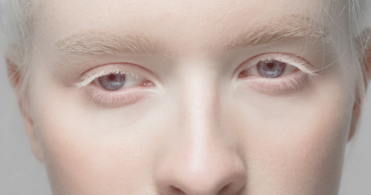 Albinisme : comprendre cette maladie rare aux implications cutanées et visuelles