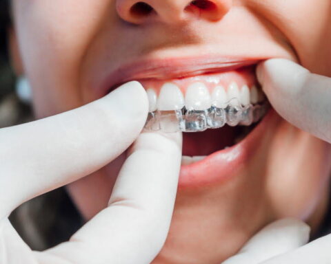 Bagues ou aligneurs : comment choisir le meilleur traitement orthodontique pour les adultes