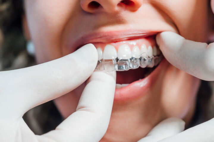 Bagues ou aligneurs : comment choisir le meilleur traitement orthodontique pour les adultes