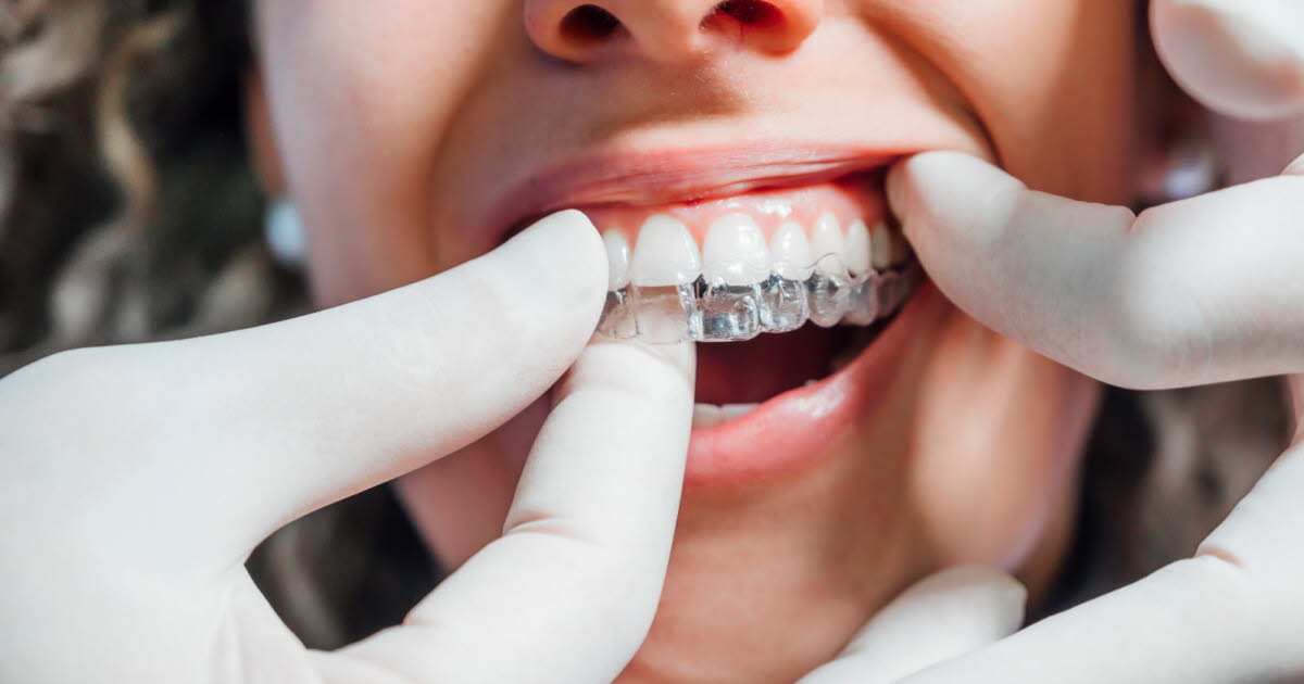 Bagues ou aligneurs : comment choisir le meilleur traitement orthodontique pour les adultes