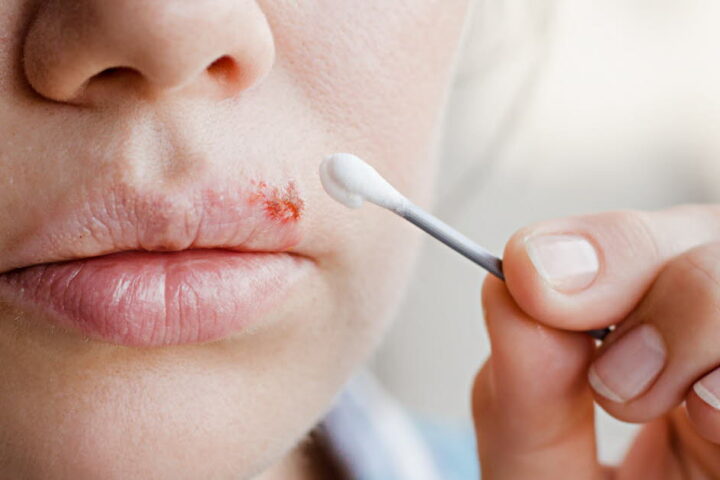 Comprendre l'herpès labial : contagion, symptômes et traitements à connaître