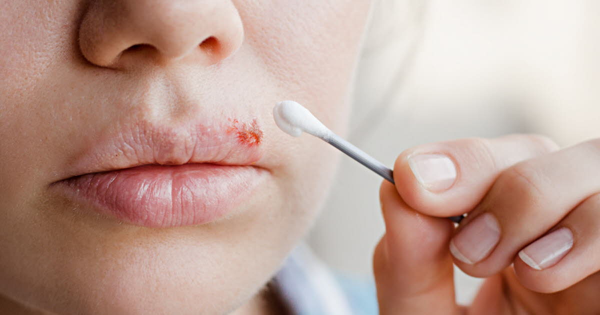 Comprendre l'herpès labial : contagion, symptômes et traitements à connaître