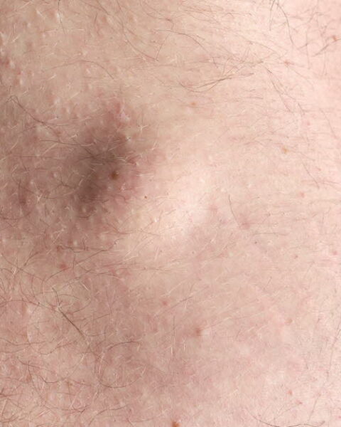 Lipomes : quand faut-il s'inquiéter et consulter un médecin ?