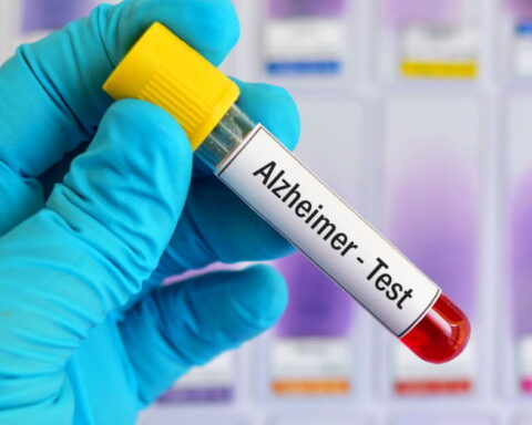 Un test sanguin pourrait prédire le risque de développer la maladie d'Alzheimer jusqu'à 25 ans à l'avance