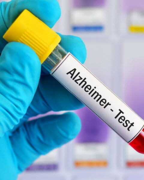 Un test sanguin pourrait prédire le risque de développer la maladie d'Alzheimer jusqu'à 25 ans à l'avance