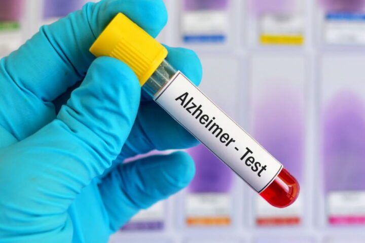 Un test sanguin pourrait prédire le risque de développer la maladie d'Alzheimer jusqu'à 25 ans à l'avance