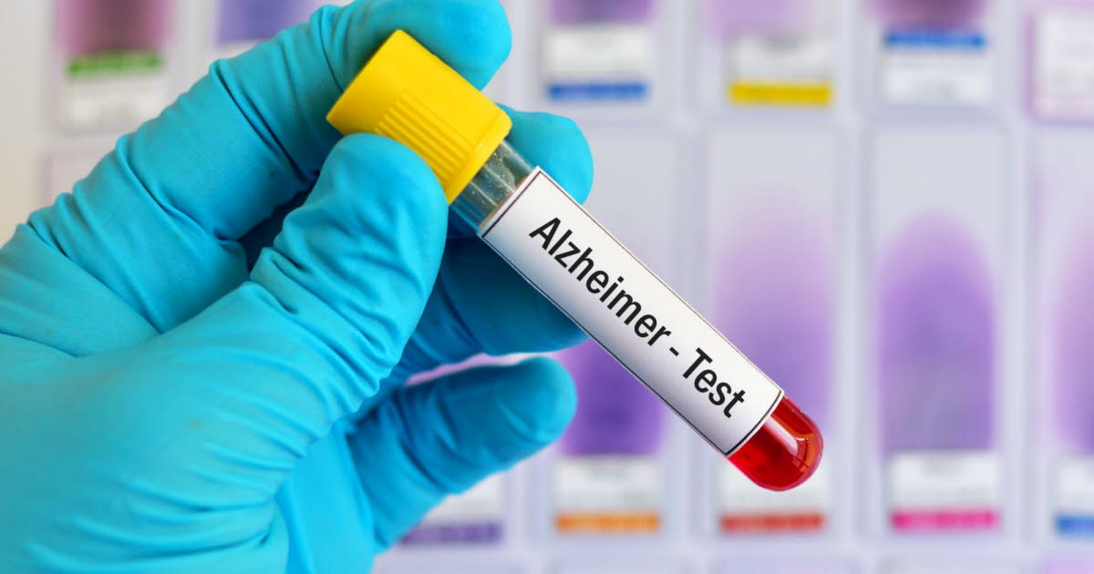 Un test sanguin pourrait prédire le risque de développer la maladie d'Alzheimer jusqu'à 25 ans à l'avance