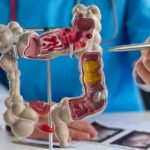 Cancer colorectal : le développement peut prendre jusqu'à dix ans selon les experts