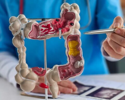 Cancer colorectal : le développement peut prendre jusqu'à dix ans selon les experts