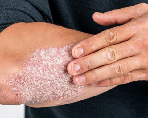 Psoriasis : reprendre le contrôle de sa vie face à la maladie en France