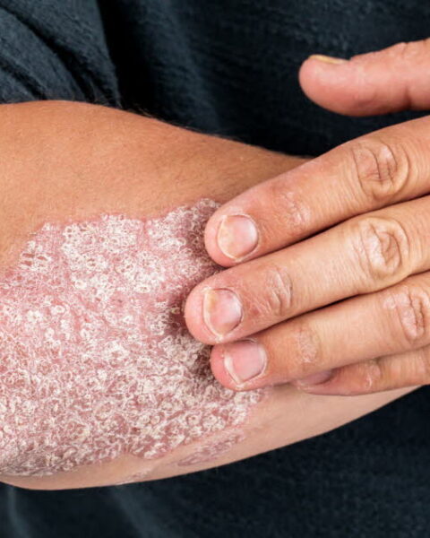 Psoriasis : reprendre le contrôle de sa vie face à la maladie en France