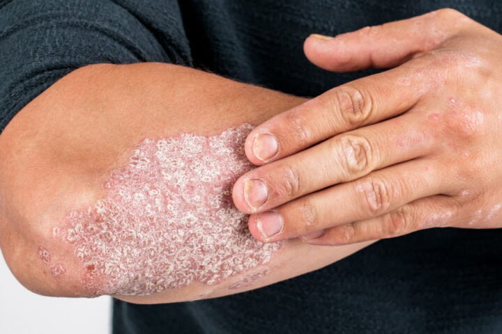 Psoriasis : reprendre le contrôle de sa vie face à la maladie en France