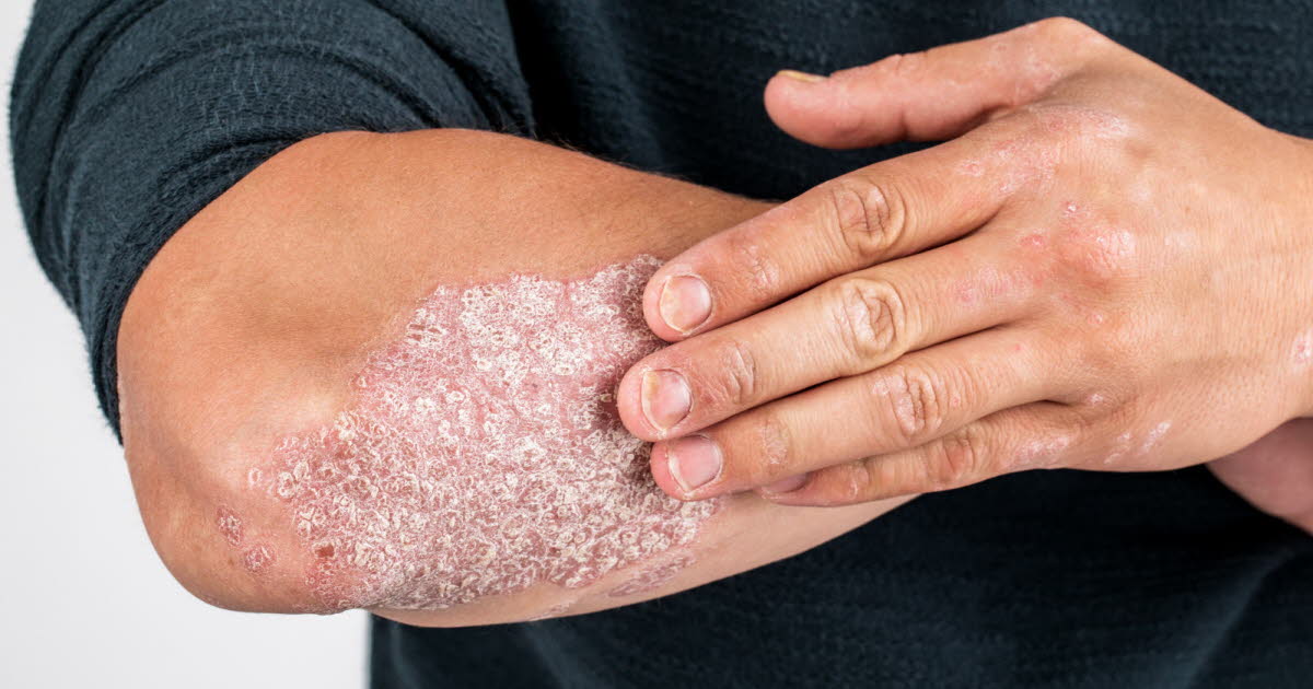 Psoriasis : reprendre le contrôle de sa vie face à la maladie en France