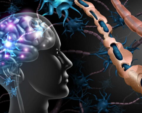 Sclérose en plaques : l'impact du vieillissement sur la prise en charge des patients