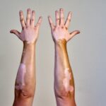Vitiligo : maladie auto-immune touchant un million de personnes en France