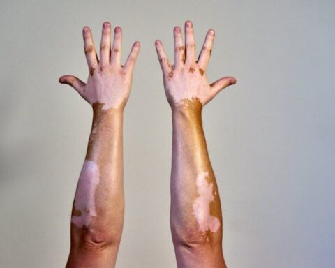 Vitiligo : maladie auto-immune touchant un million de personnes en France