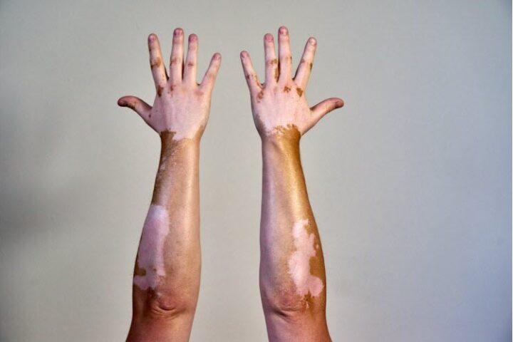 Vitiligo : maladie auto-immune touchant un million de personnes en France