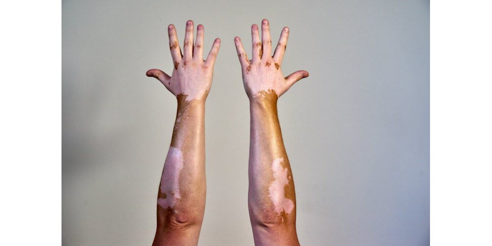 Vitiligo : maladie auto-immune touchant un million de personnes en France