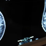 Après une ablation du sein, une femme découvre qu'elle n'a jamais eu de cancer