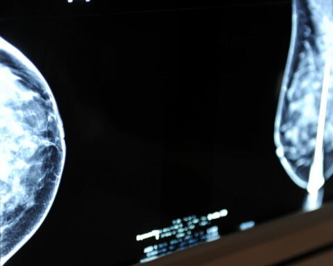 Après une ablation du sein, une femme découvre qu'elle n'a jamais eu de cancer