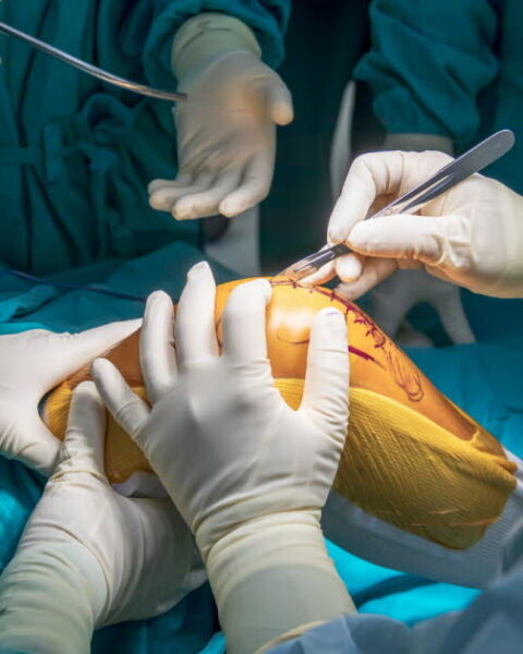 Chirurgie du genou : la méniscectomie partielle jugée inefficace et nocive selon des chercheurs finlandais