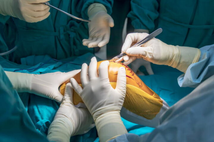 Chirurgie du genou : la méniscectomie partielle jugée inefficace et nocive selon des chercheurs finlandais