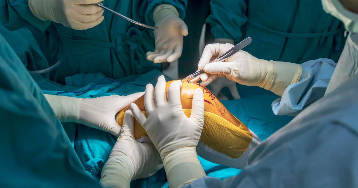 Chirurgie du genou : la méniscectomie partielle jugée inefficace et nocive selon des chercheurs finlandais