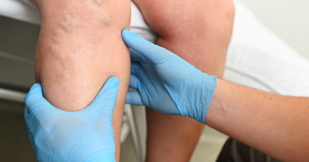 Comprendre la phlébite : symptômes, risques et traitements à connaître