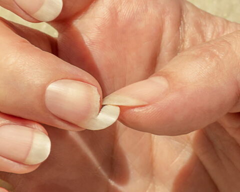 Causes des ongles cassants et solutions efficaces pour les traiter