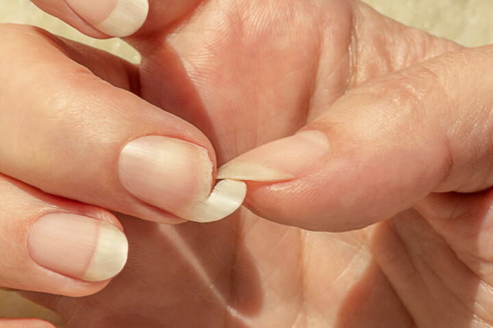Causes des ongles cassants et solutions efficaces pour les traiter