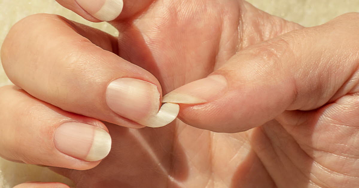 Causes des ongles cassants et solutions efficaces pour les traiter