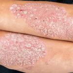Découverte génétique majeure pour un traitement sur mesure du psoriasis en France