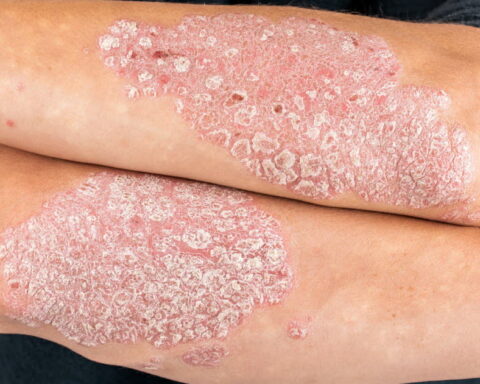 Découverte génétique majeure pour un traitement sur mesure du psoriasis en France
