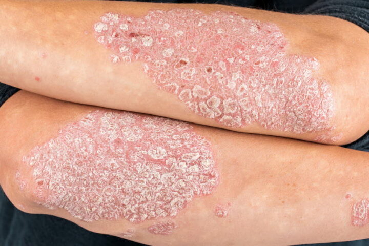 Découverte génétique majeure pour un traitement sur mesure du psoriasis en France