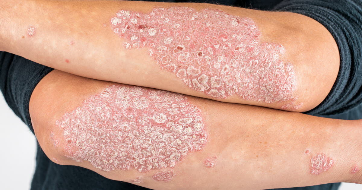 Découverte génétique majeure pour un traitement sur mesure du psoriasis en France