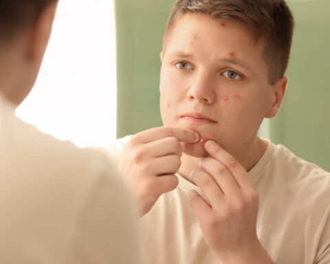 L'impact de la tendance #Pimplepopping sur la santé de la peau et les risques d'infection