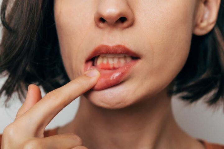 Pourquoi il est crucial de ne pas ignorer les gencives qui saignent