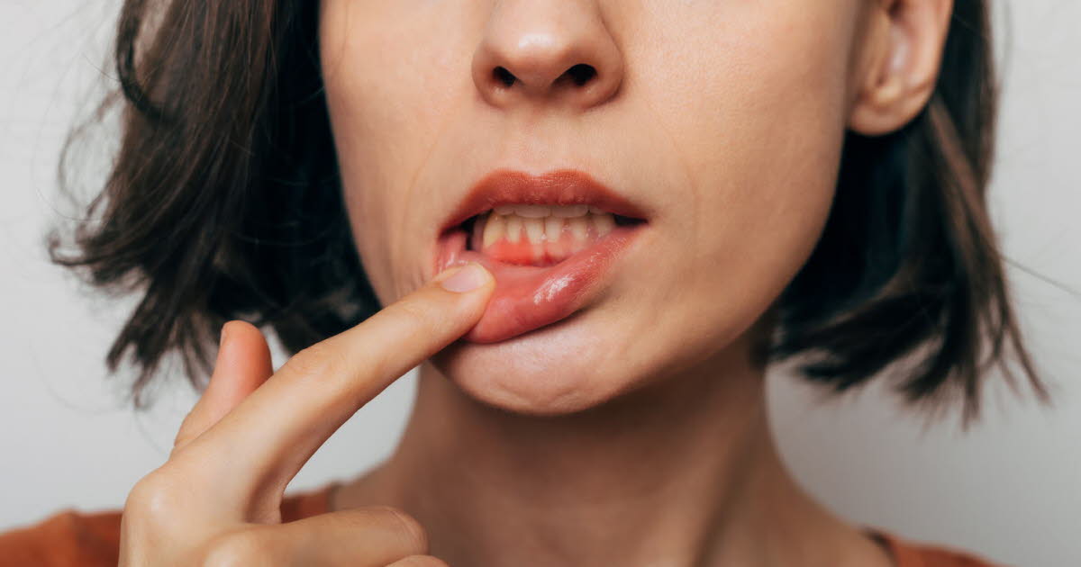 Pourquoi il est crucial de ne pas ignorer les gencives qui saignent