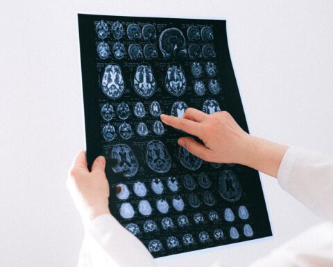 Un Gallois découvre un glioblastome après avoir consulté sur l'insistance de sa femme