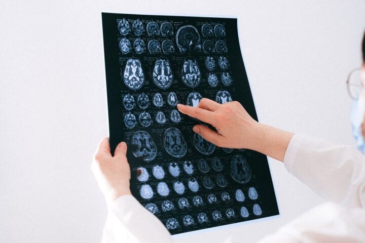 Un Gallois découvre un glioblastome après avoir consulté sur l'insistance de sa femme