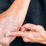 Psoriasis : une mutation génétique découverte, offrant l’espoir de nouveaux traitements