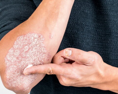 Psoriasis : une mutation génétique découverte, offrant l’espoir de nouveaux traitements