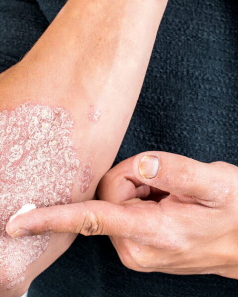 Psoriasis : une mutation génétique découverte, offrant l’espoir de nouveaux traitements